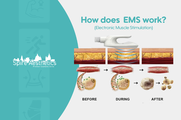 EMS treatment for post pregnancy weight loss treatment Malmesbury