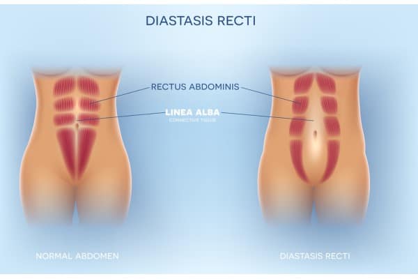 What Non-Surgical Options Are Available for Diastasis Recti Malmesbury?