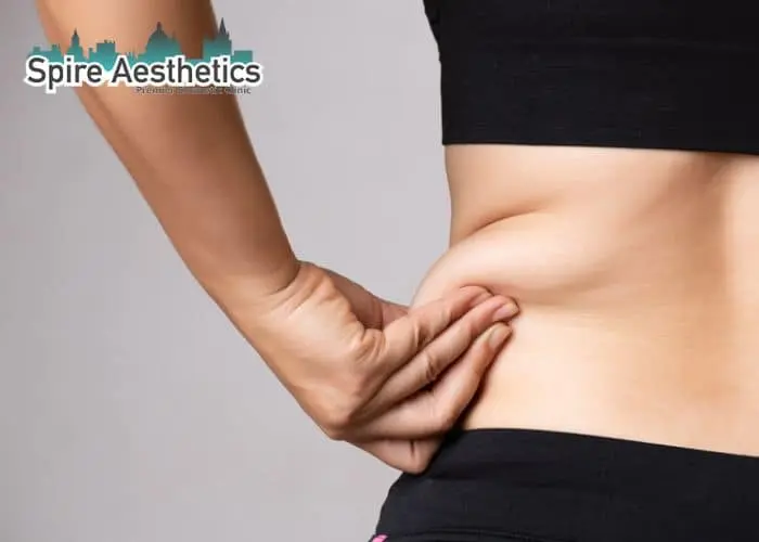 Image of woman pinching fat on their hips Malmesbury. Fat Freezing treatment