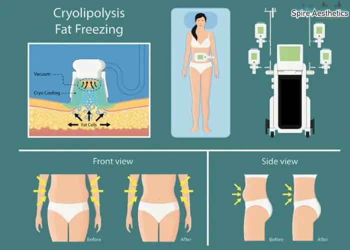 Fat freezing treatment Malmesbury benefits for competitions to remove stubborn fat deposits.