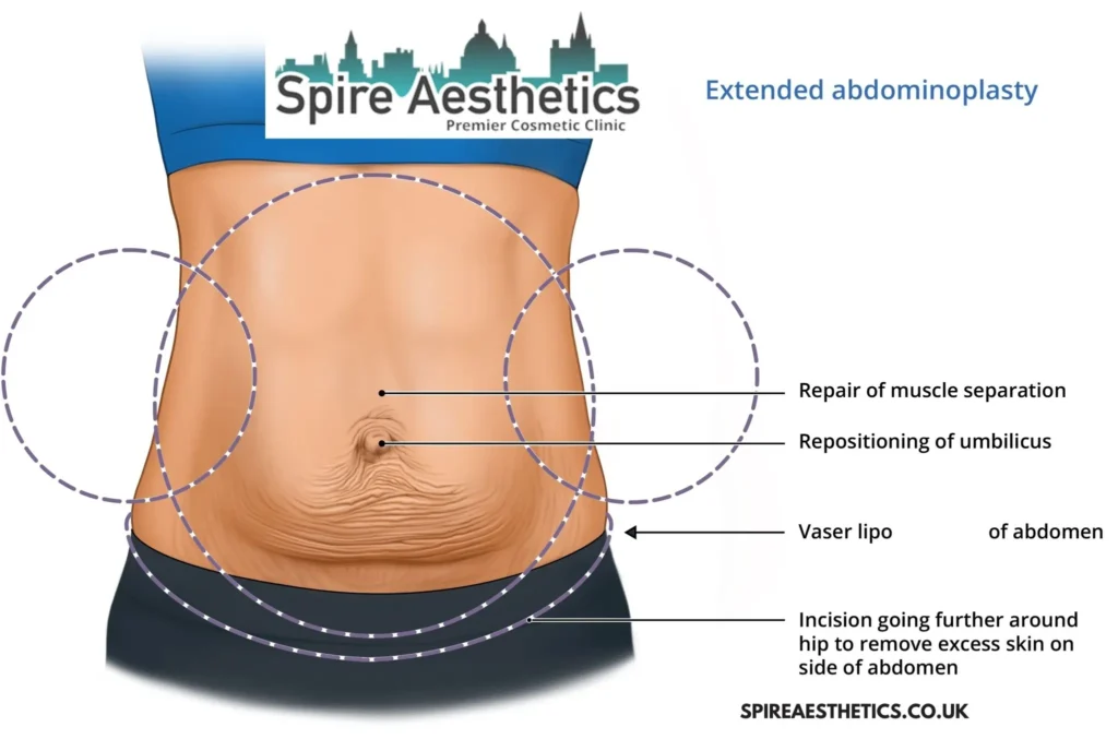Understanding Loose Skin After Gastric Band Malmesbury Surgery and HIFU Treatment