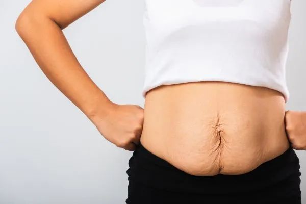 Image of a woman's stomach after weight loss with sagging skin following a gastric band Malmesbury
