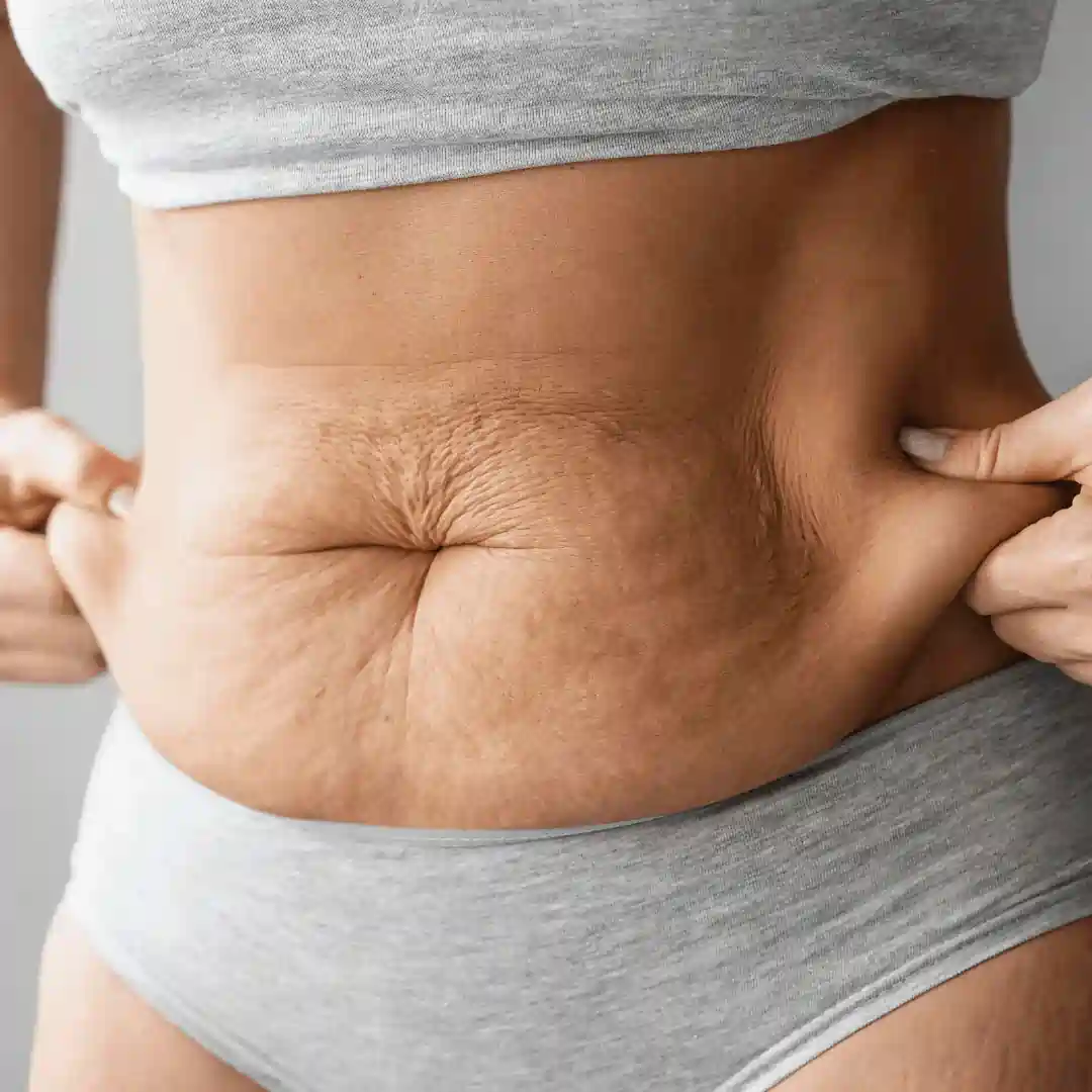 Is It Normal to Have Loose Skin After Pregnancy Malmesbury?