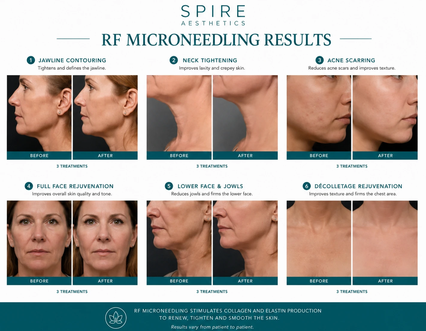 RF Microneedling Skin tightening Malmesbury results