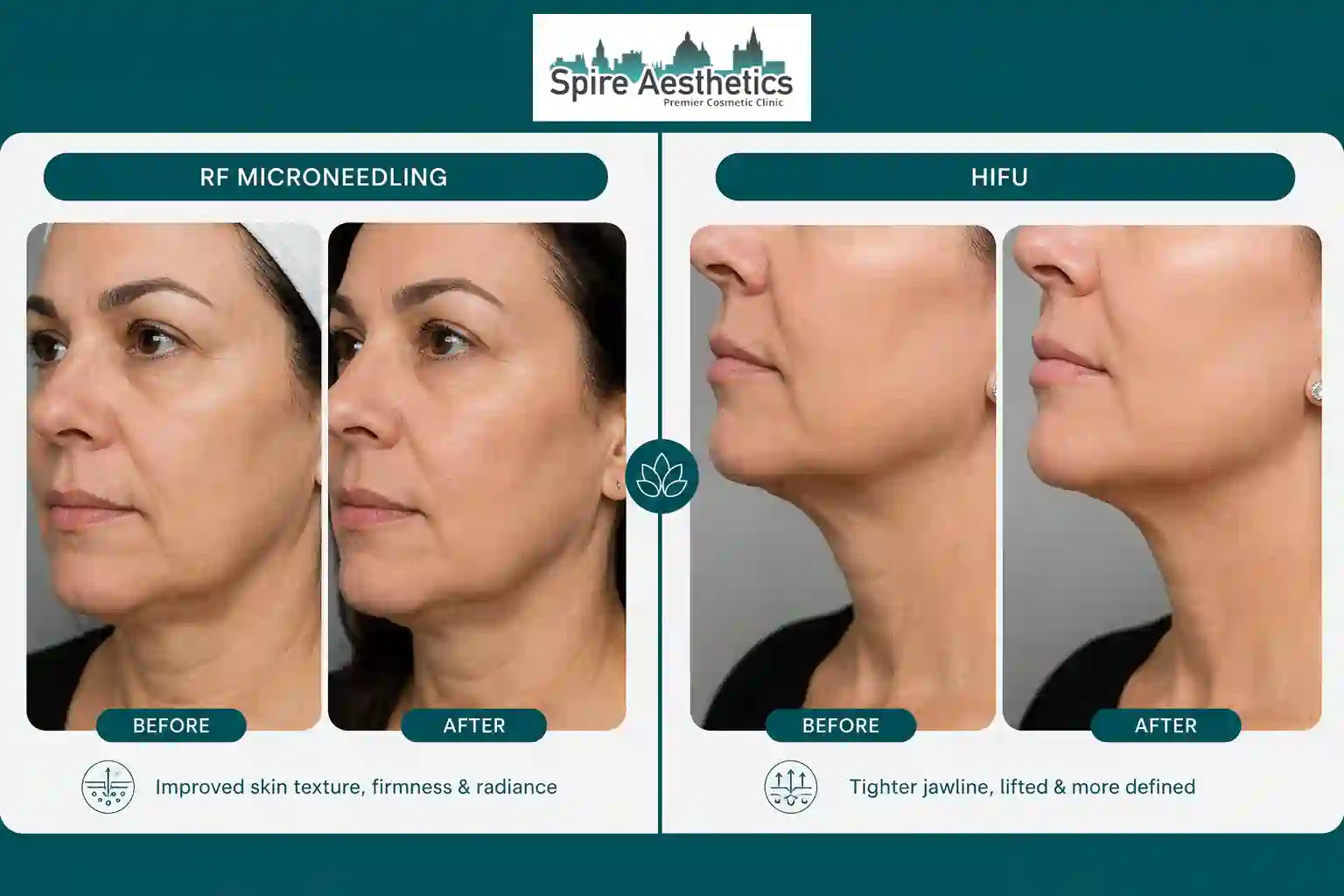 Can RF Microneedling and HIFU Be Combined Malmesbury?