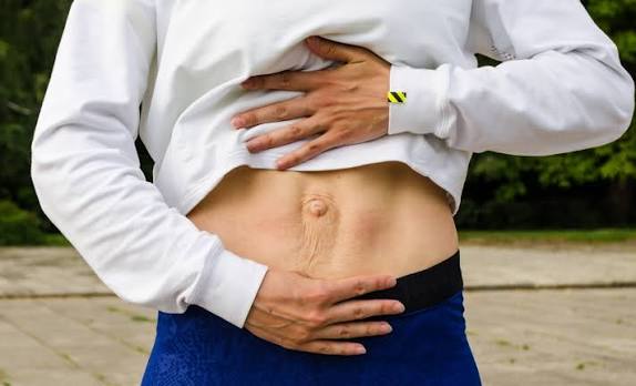 When Could Diastasis Recti Be the Missing Piece of the Puzzle Malmesbury?
